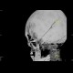 Fissure of skull, pneumocephalus, contusion: CT - Computed tomography